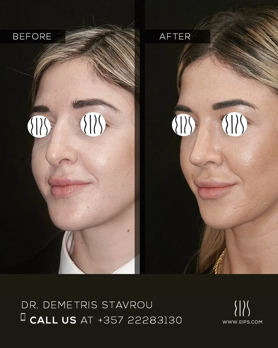 Rhinoplasty before and after