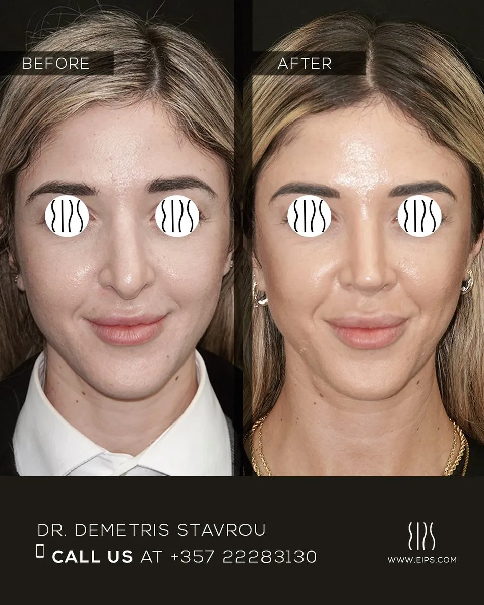 Rhinoplasty before and after