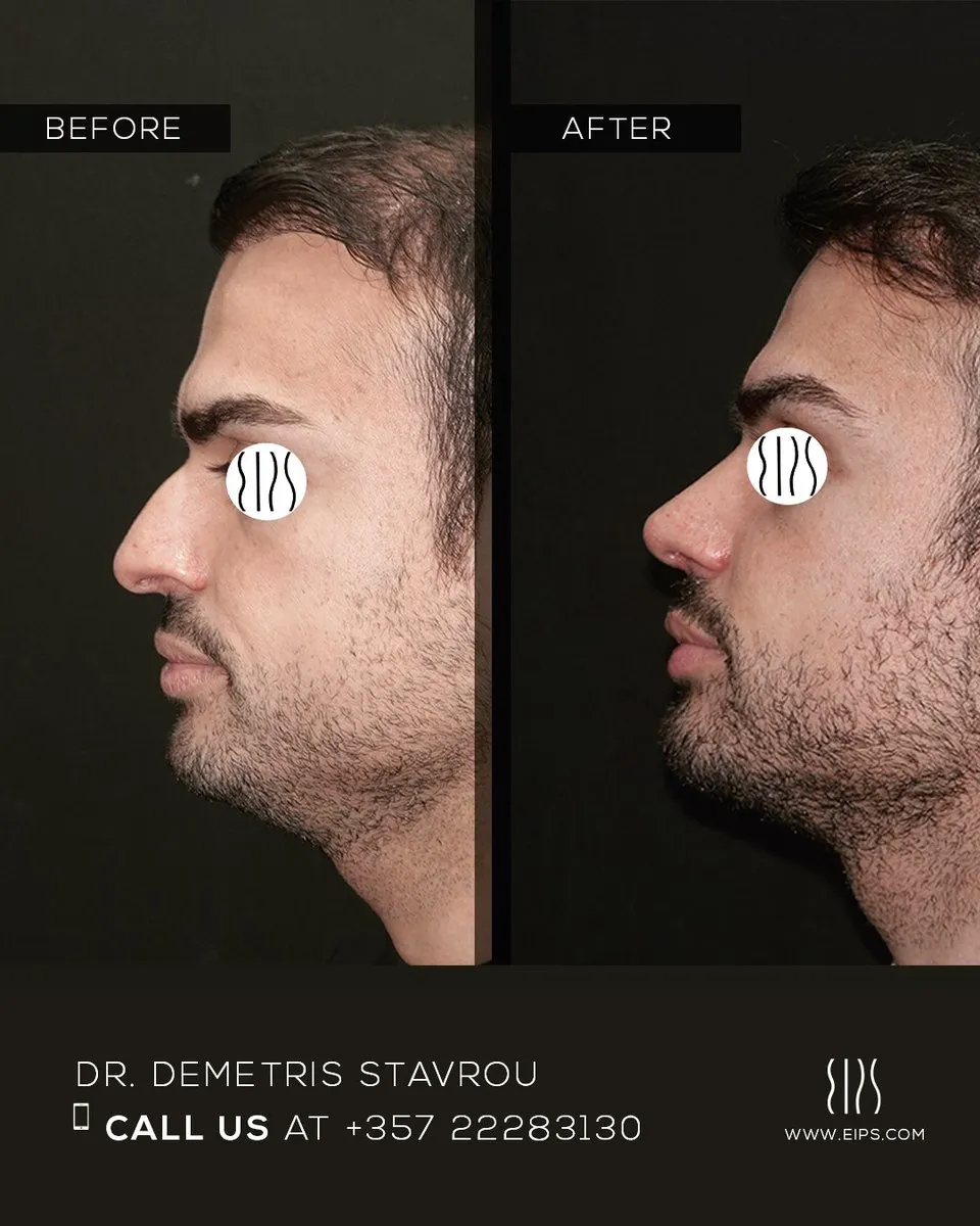 Rhinoplasty before and after