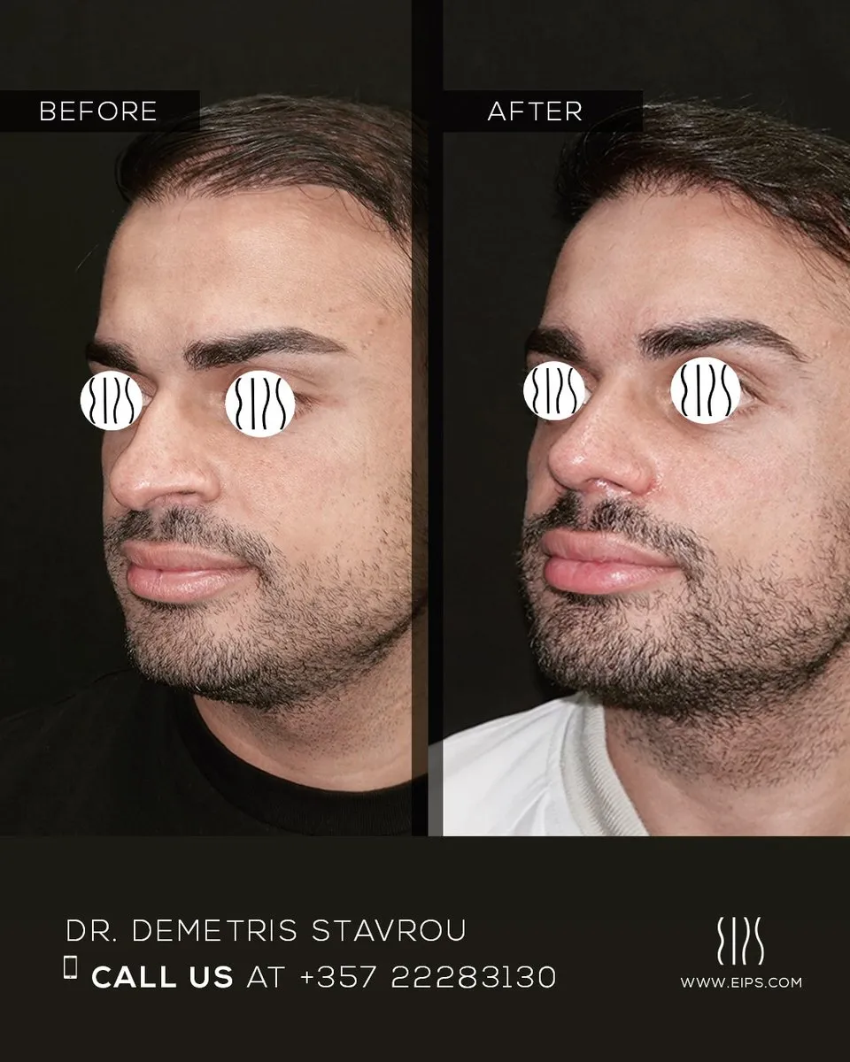 Rhinoplasty before and after