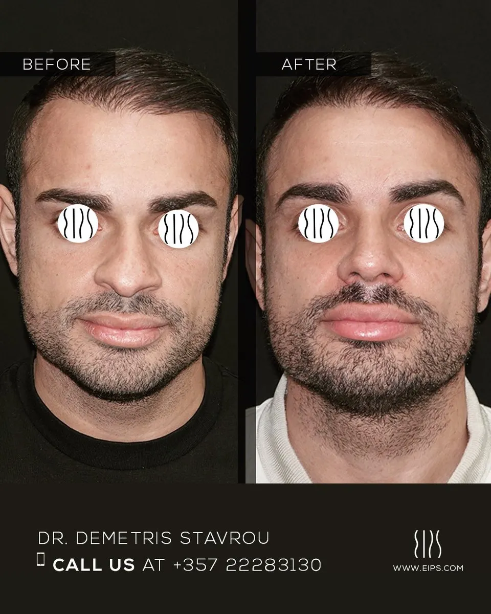 Rhinoplasty before and after