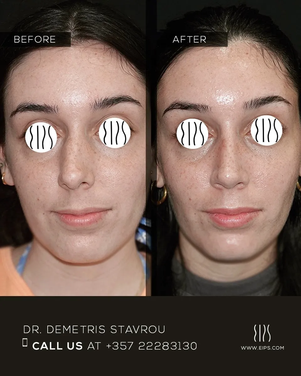 Rhinoplasty before and after