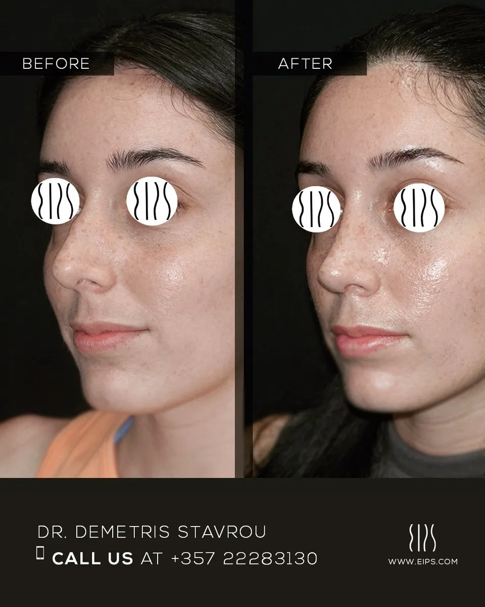 Rhinoplasty before and after