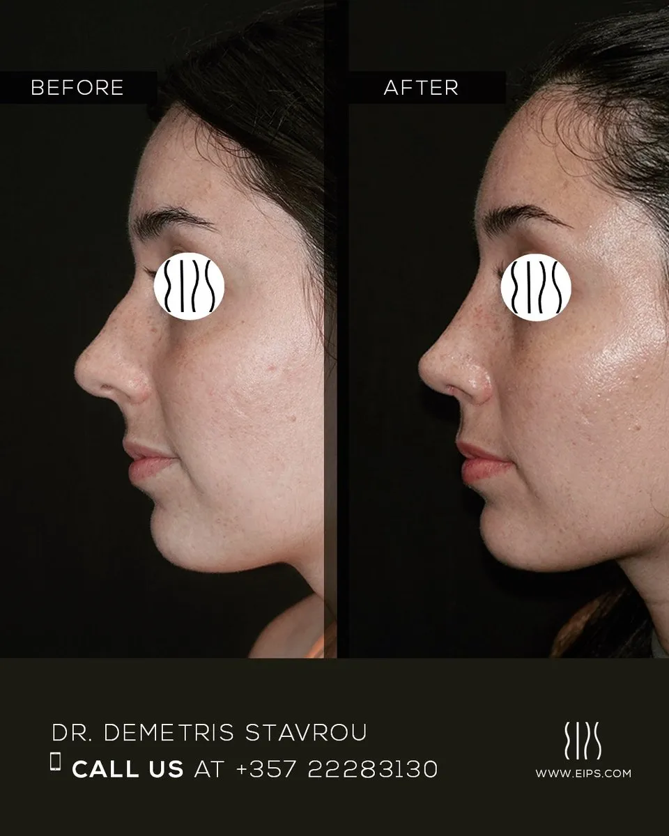 Rhinoplasty before and after