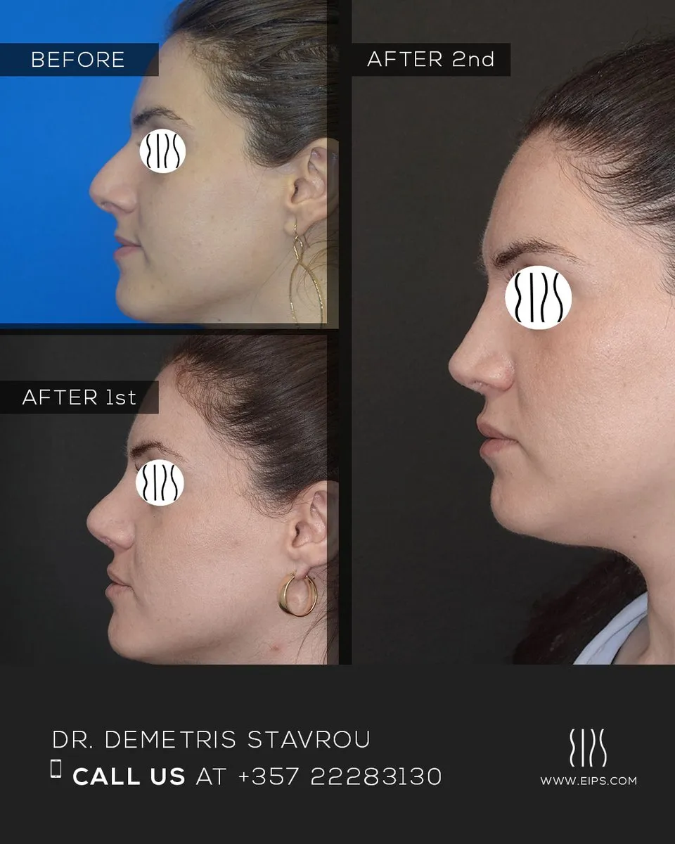 Rhinoplasty before and after