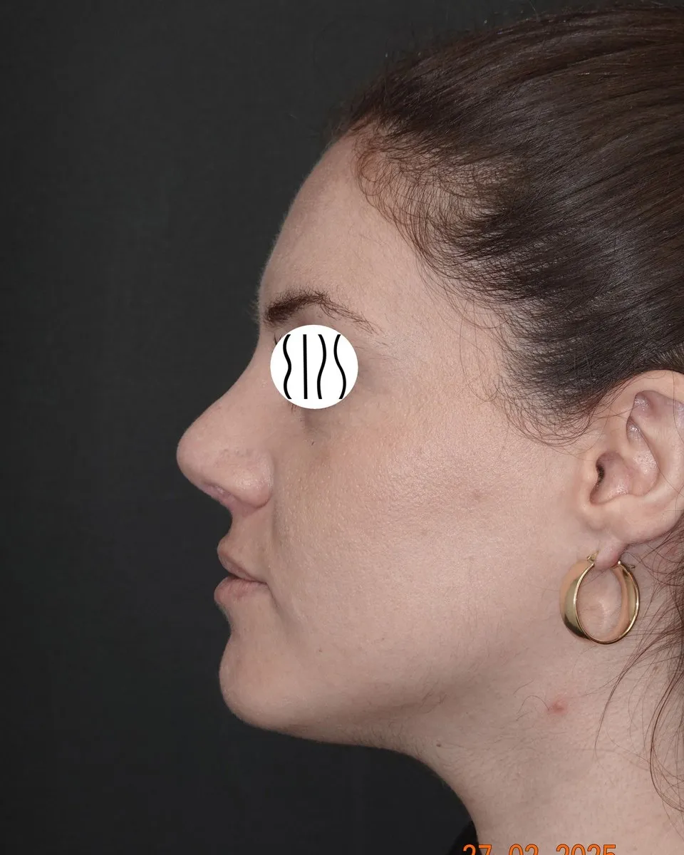 Rhinoplasty before and after
