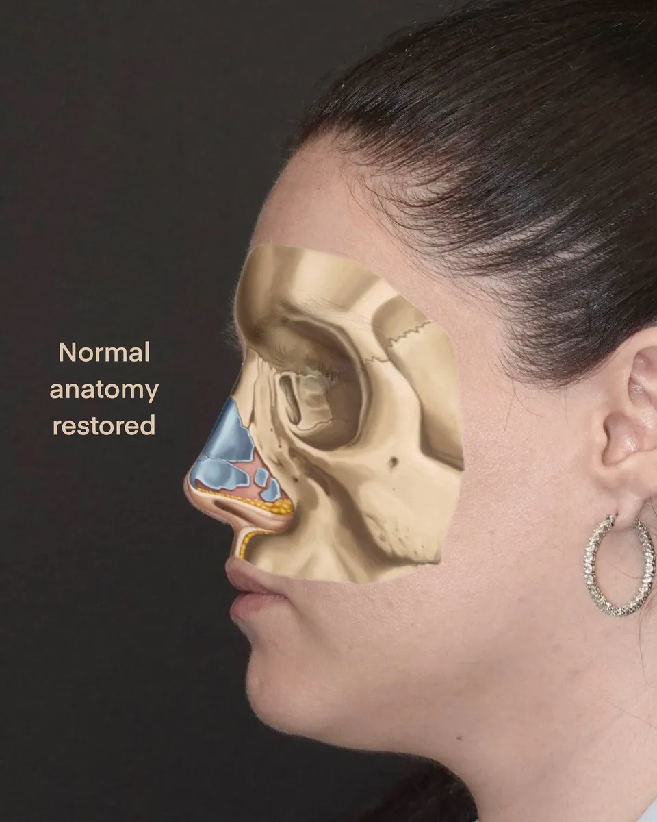 Rhinoplasty before and after
