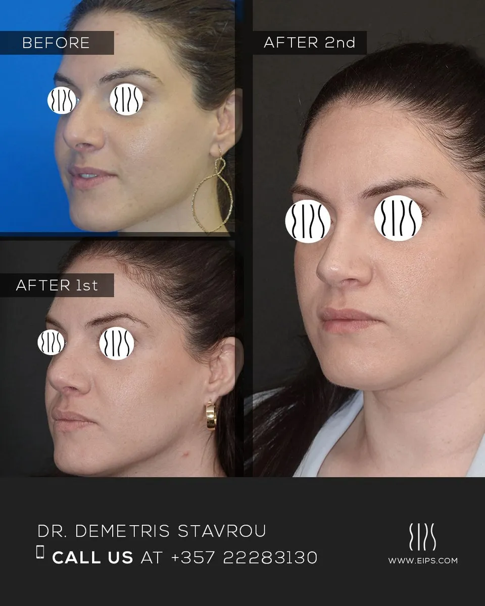 Rhinoplasty before and after