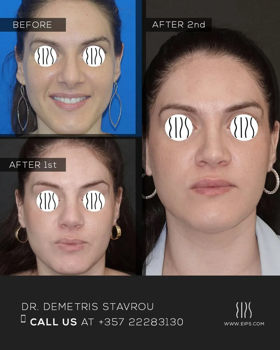 Rhinoplasty before and after