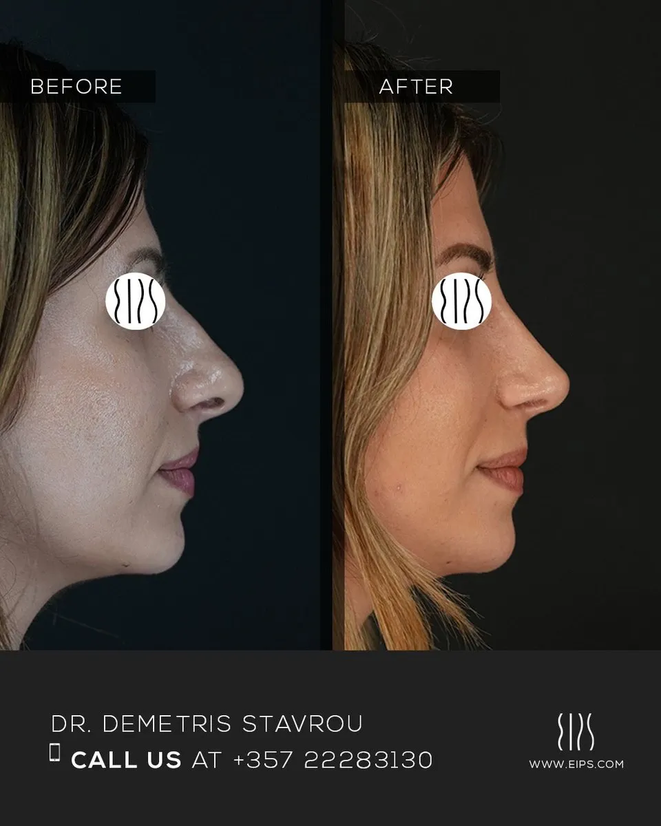 Rhinoplasty before and after