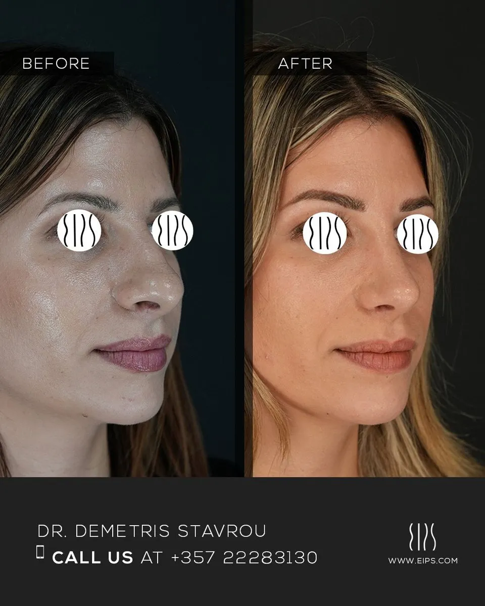 Rhinoplasty before and after