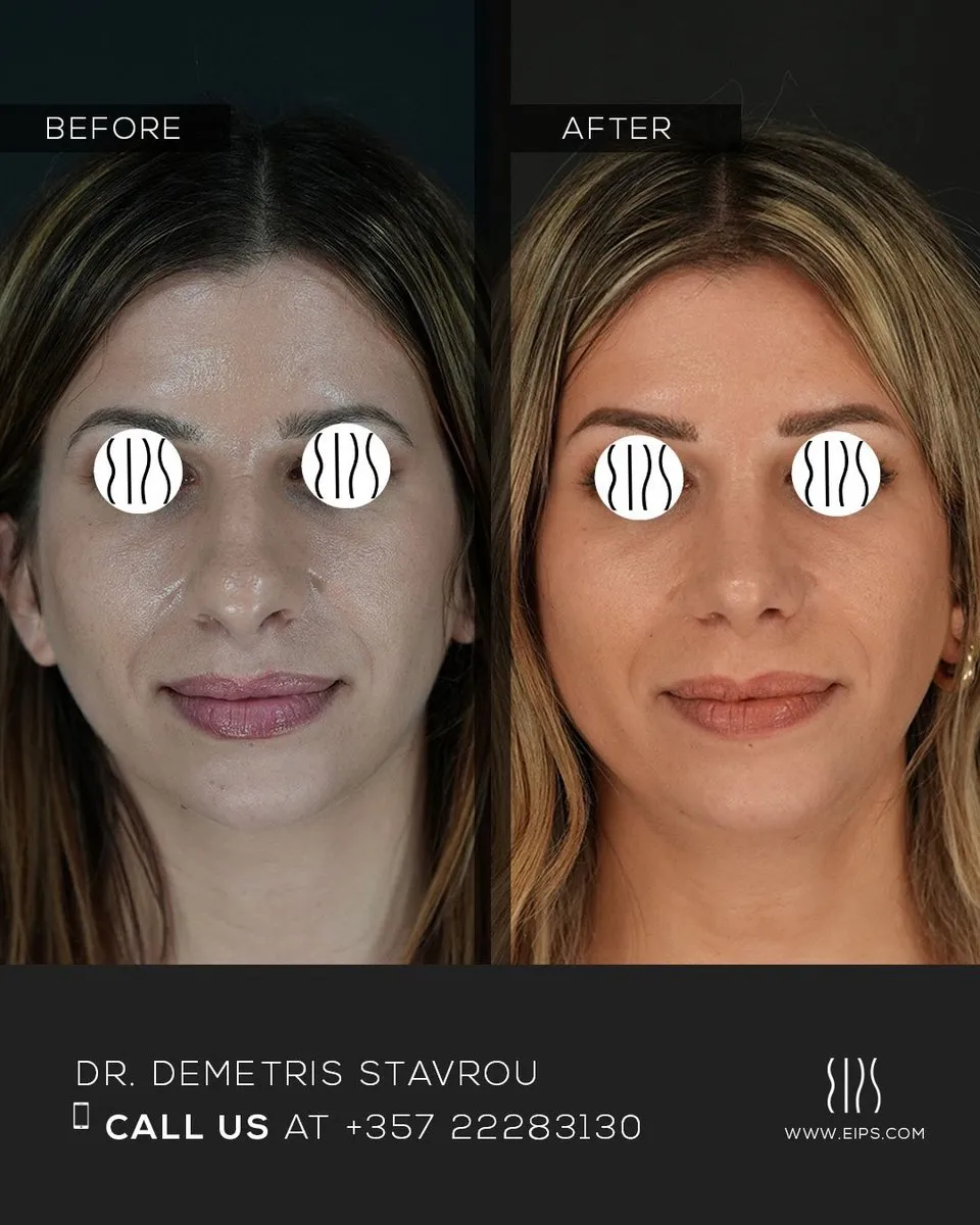 Rhinoplasty before and after
