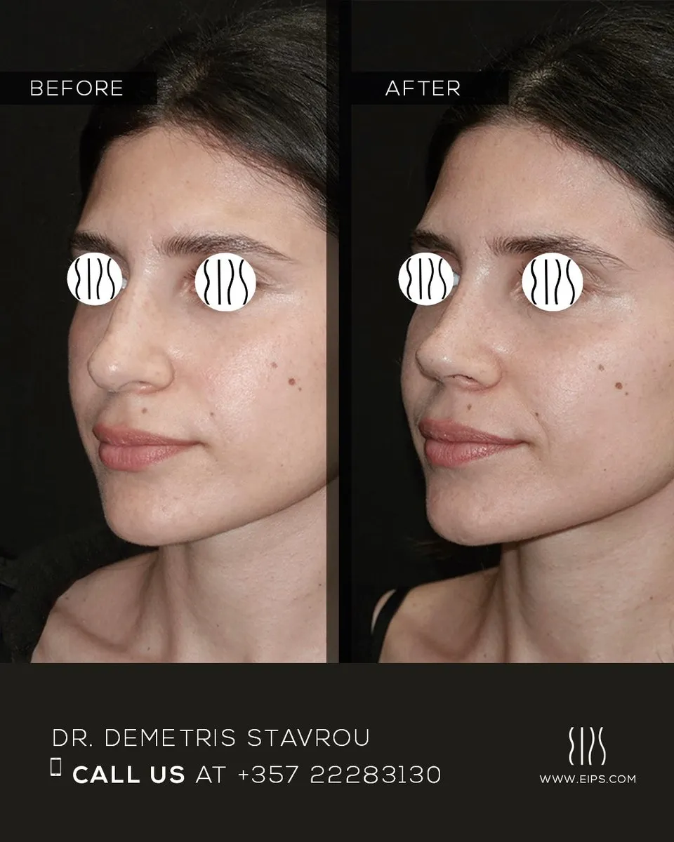 Rhinoplasty before and after