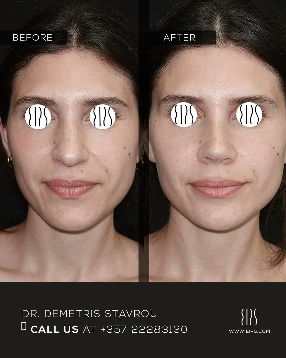 Rhinoplasty before and after