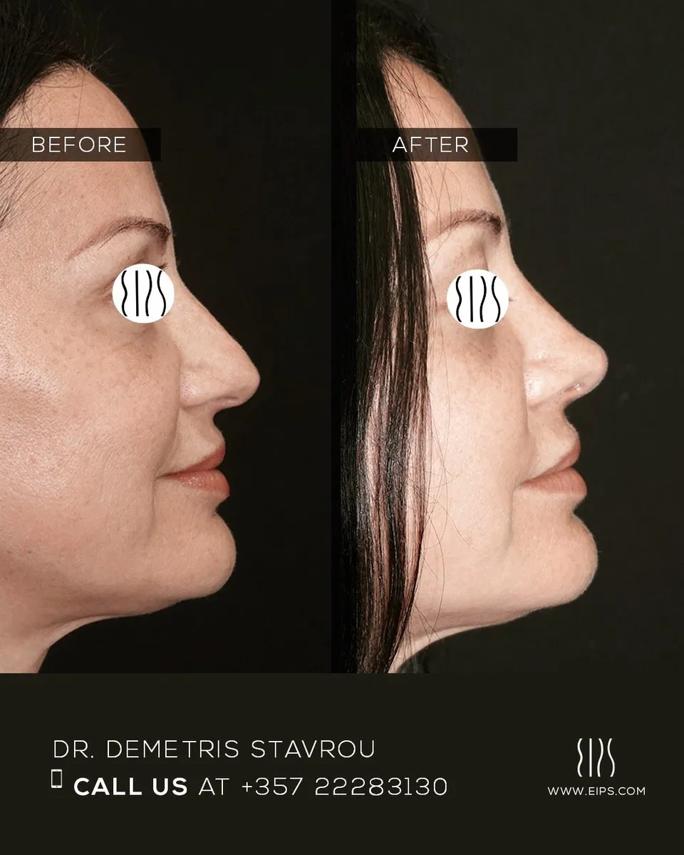 Rhinoplasty before and after