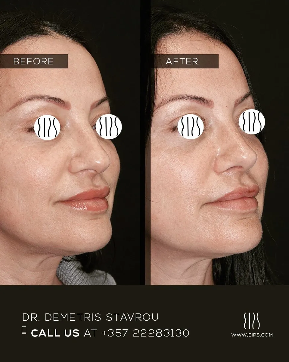 Rhinoplasty before and after
