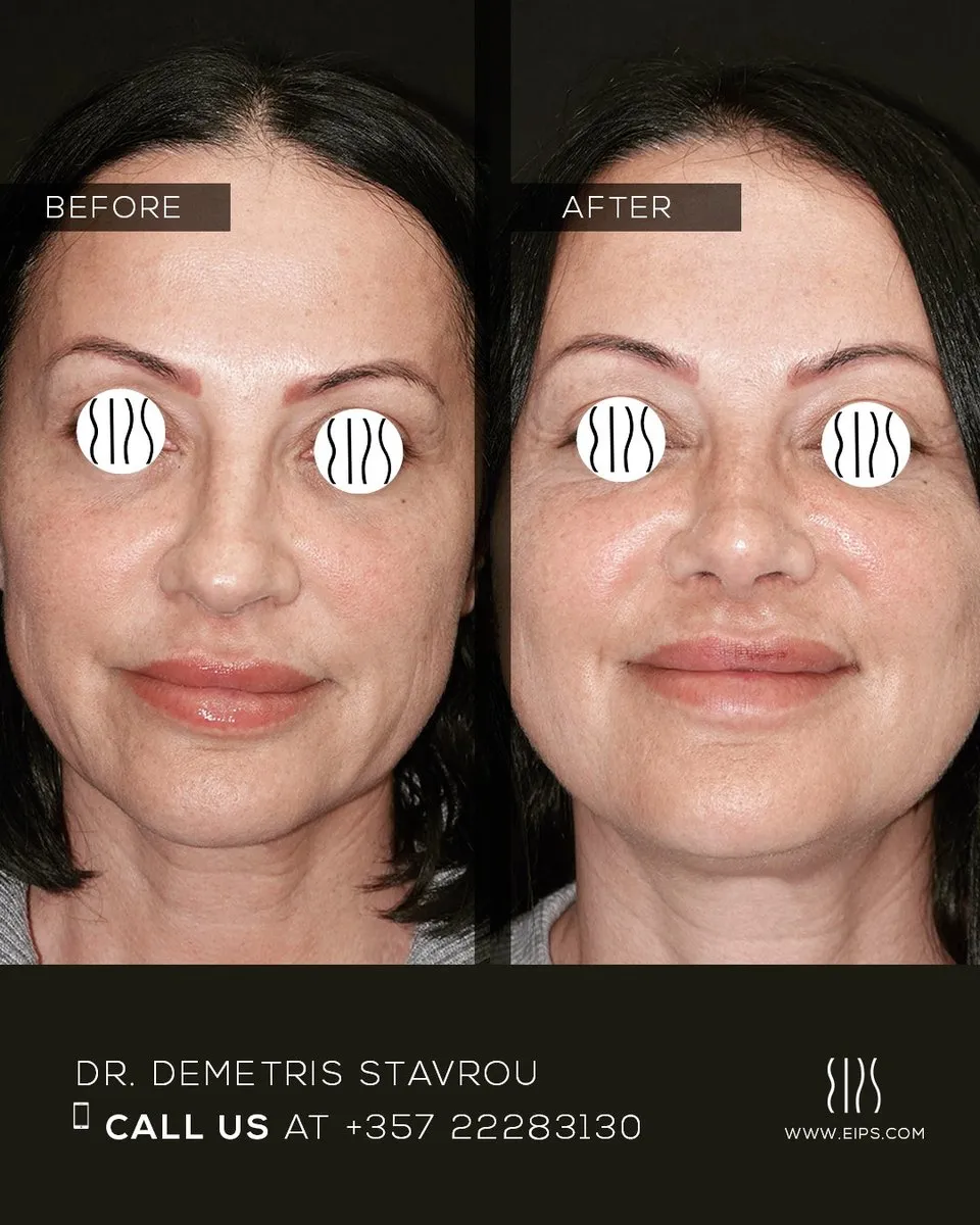 Rhinoplasty before and after