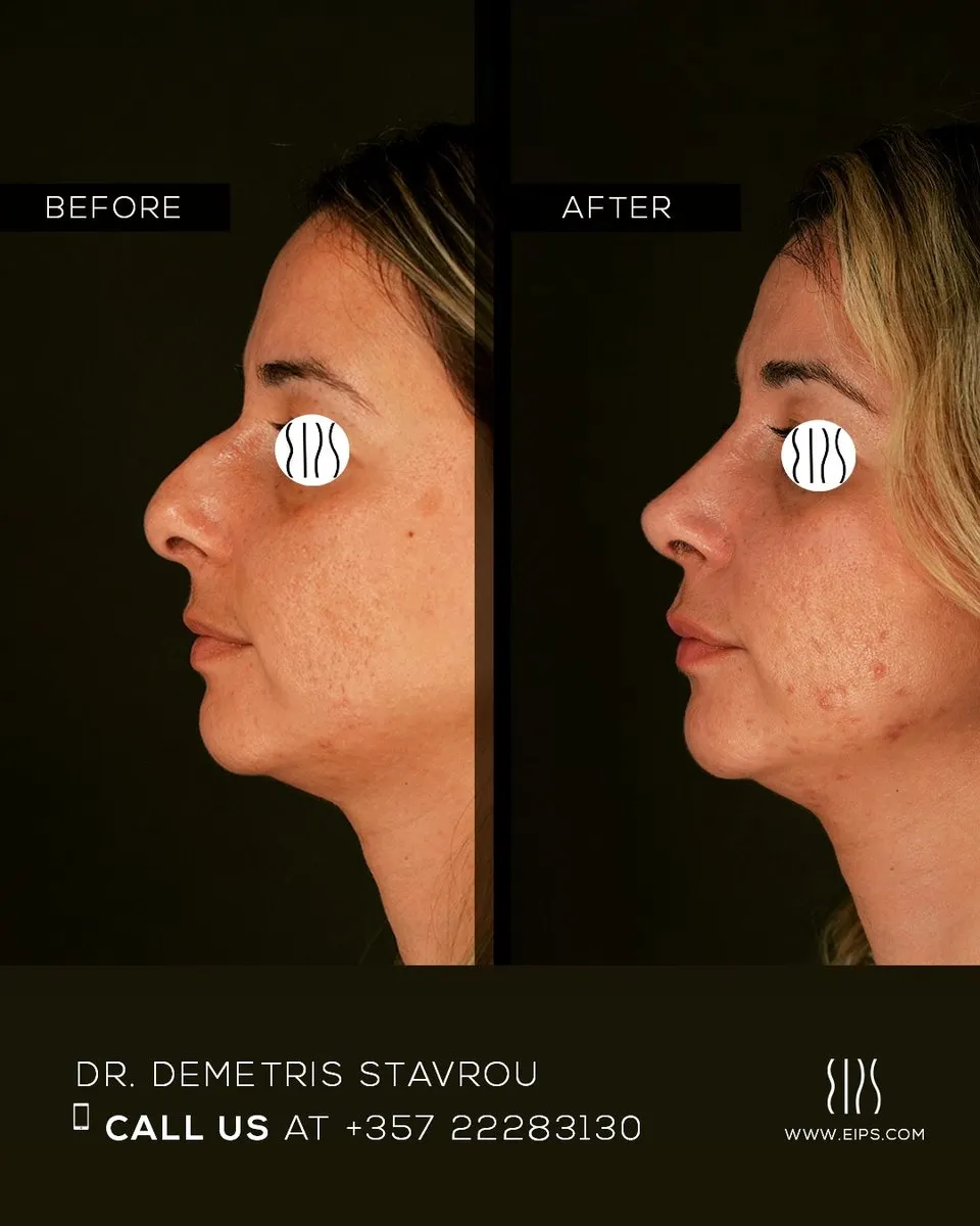 Rhinoplasty before and after