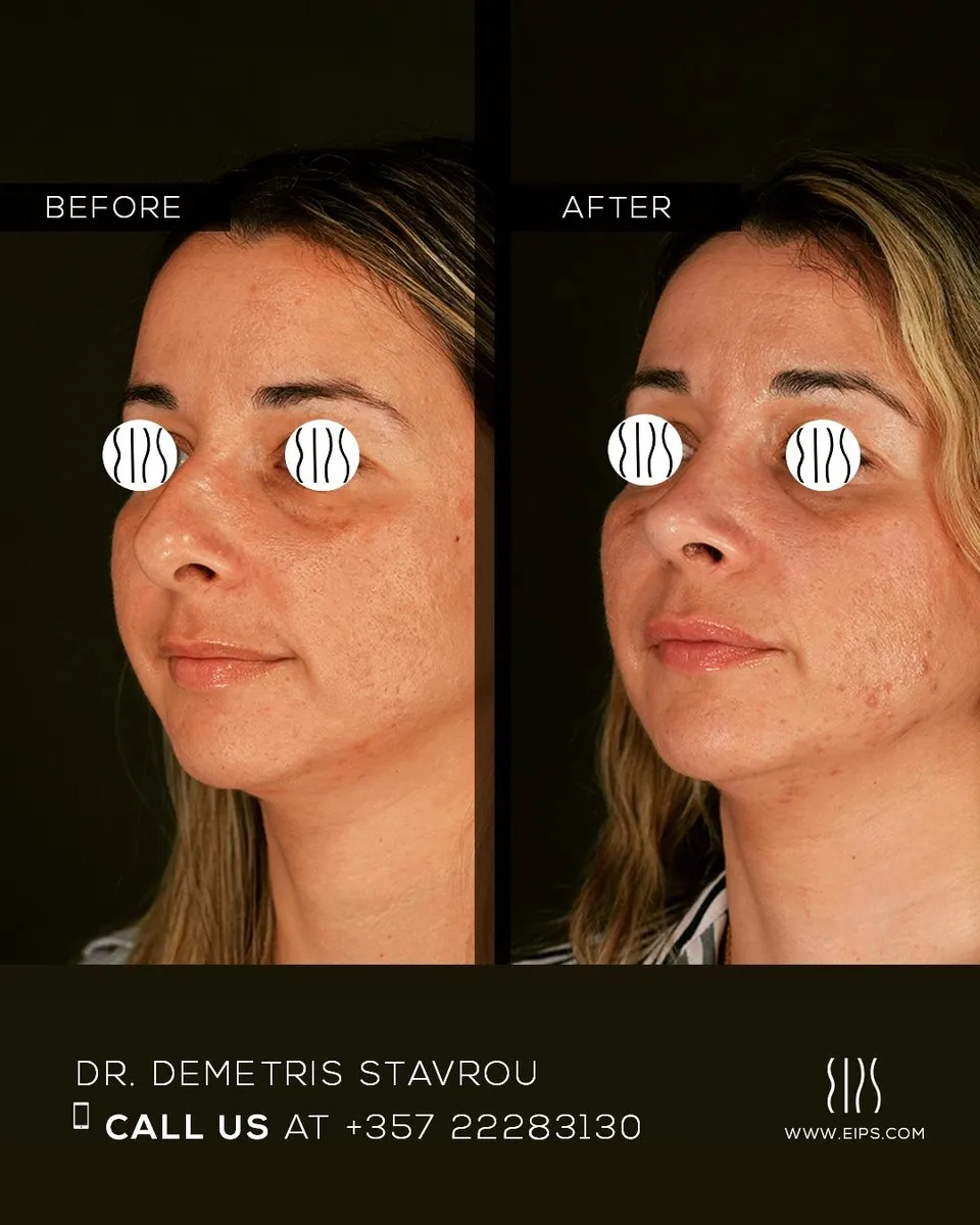 Rhinoplasty before and after
