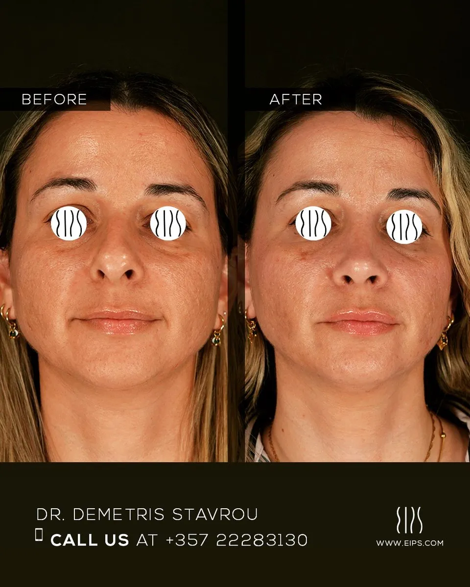 Rhinoplasty before and after