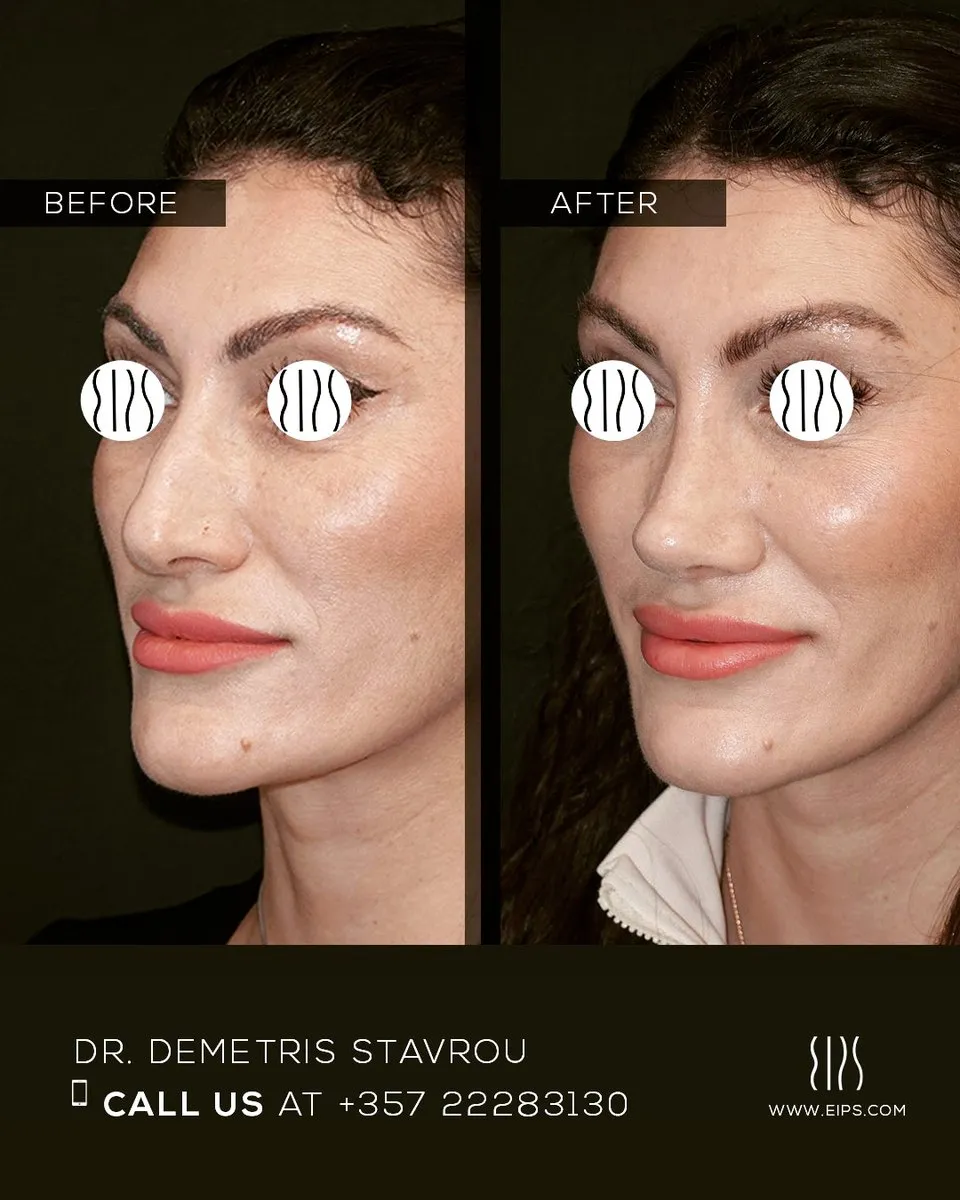 Rhinoplasty before and after
