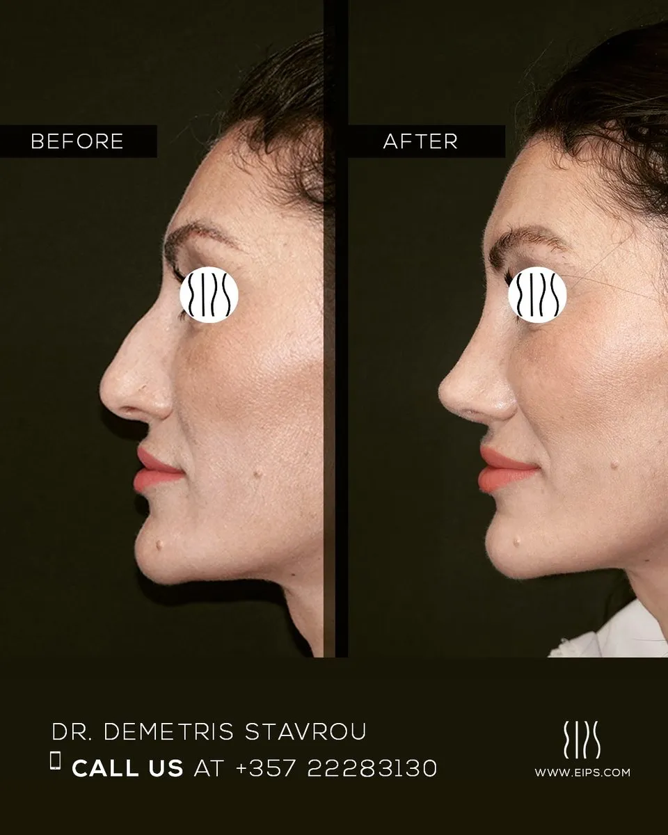 Rhinoplasty before and after