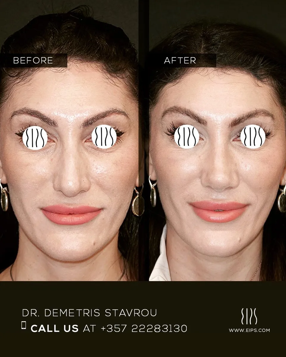 Rhinoplasty before and after