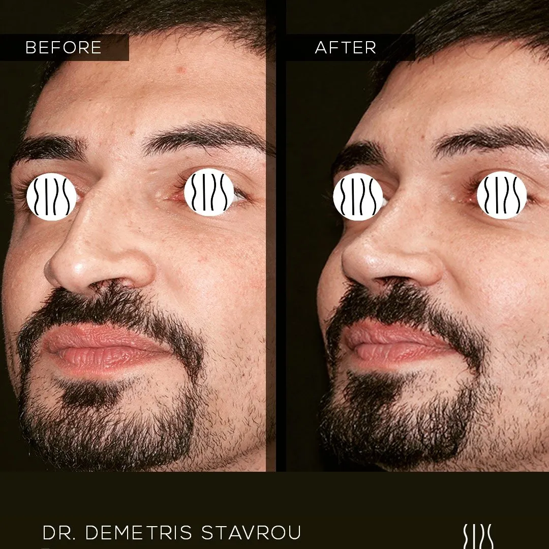 Rhinoplasty before and after