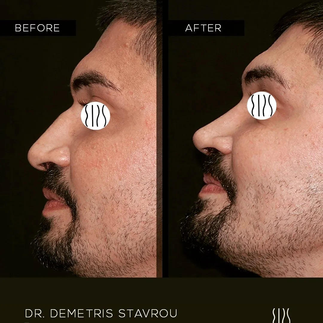 Rhinoplasty before and after