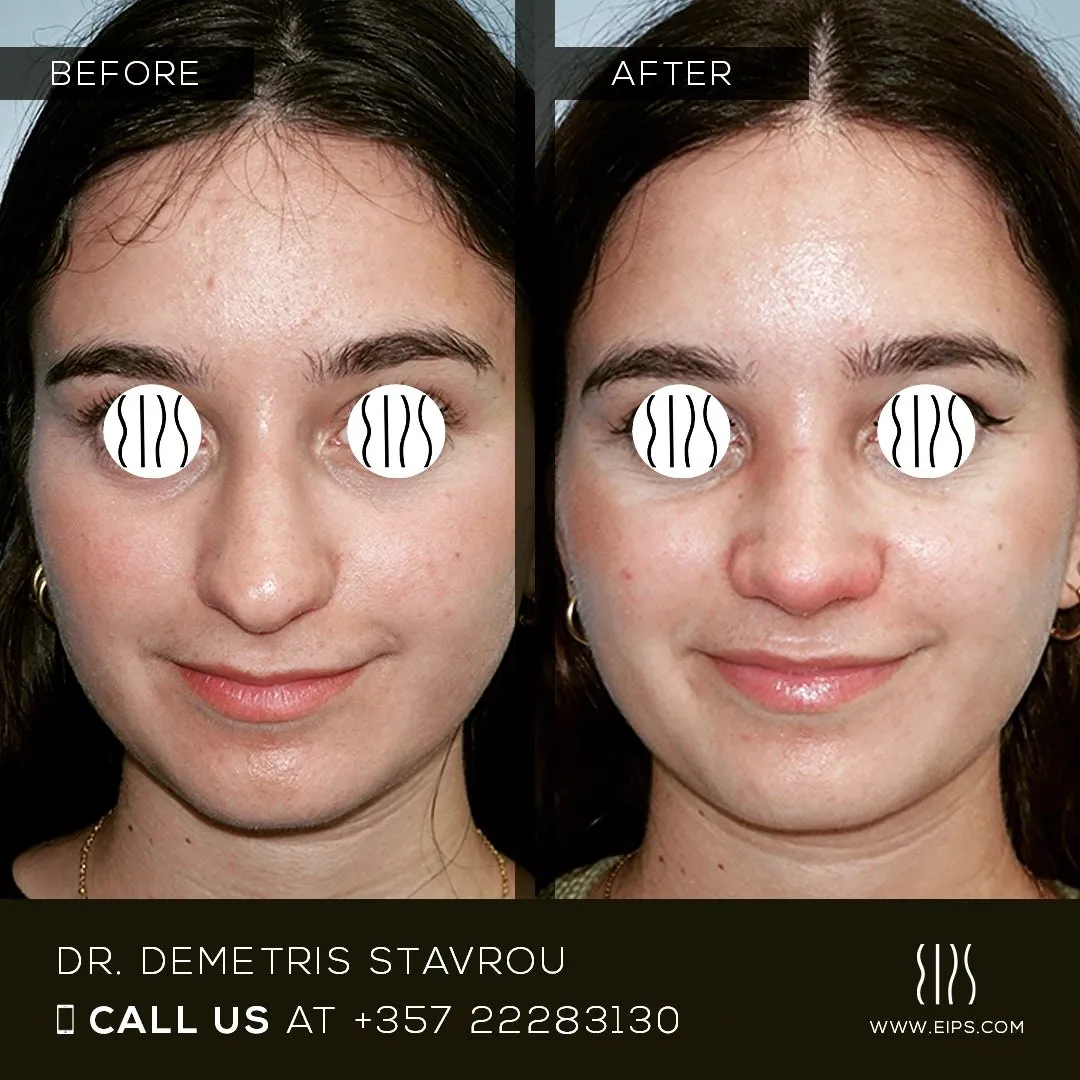 Rhinoplasty before and after
