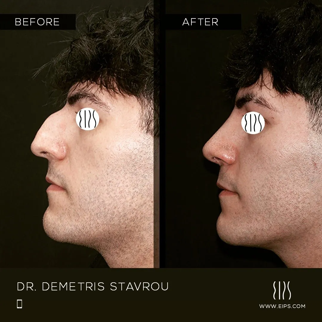 Rhinoplasty before and after