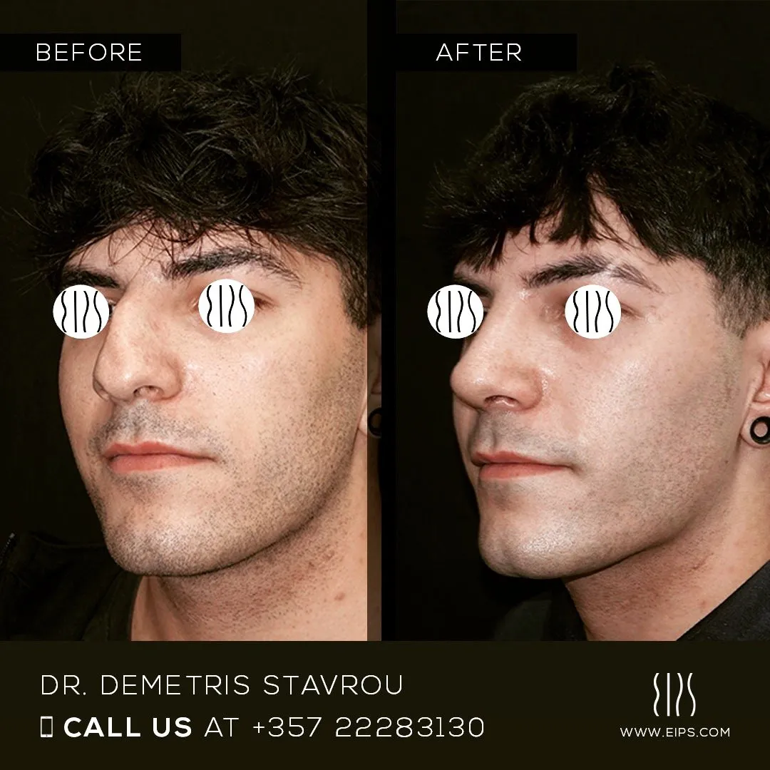 Rhinoplasty before and after