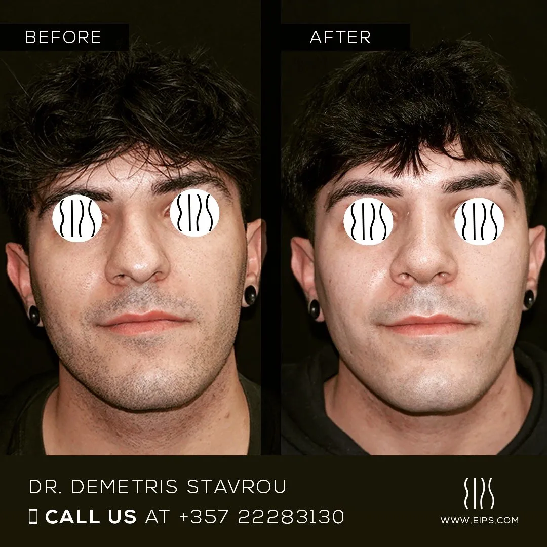 Rhinoplasty before and after