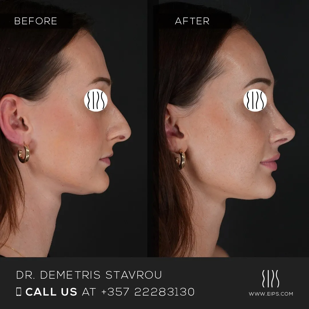 Rhinoplasty before and after