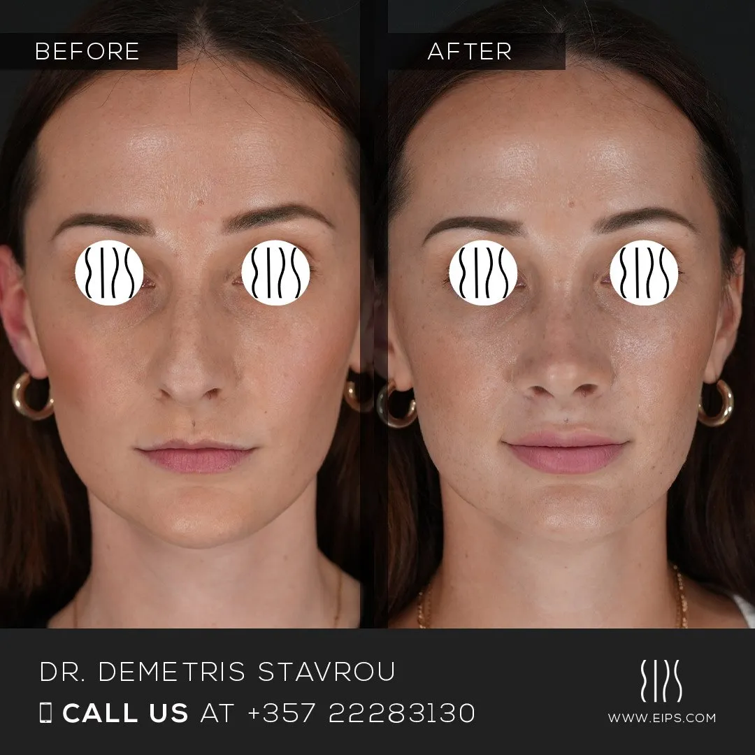 Rhinoplasty before and after