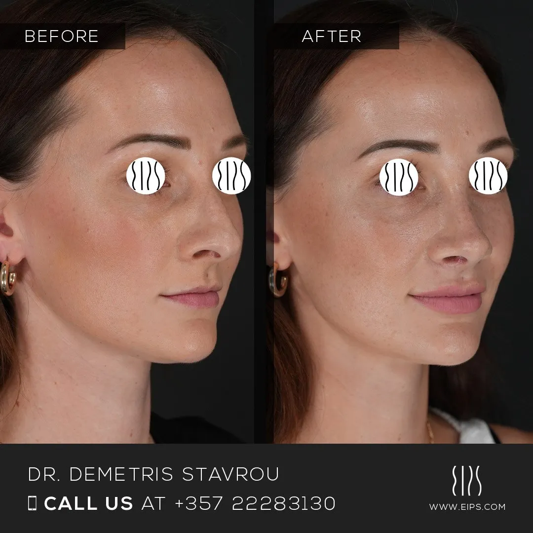 Rhinoplasty before and after