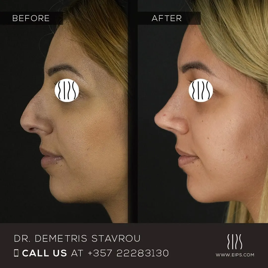 Rhinoplasty before and after