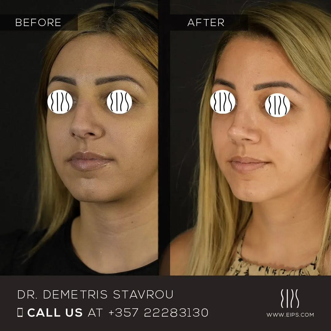 Rhinoplasty before and after