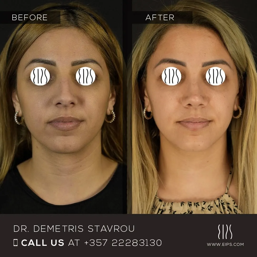 Rhinoplasty before and after