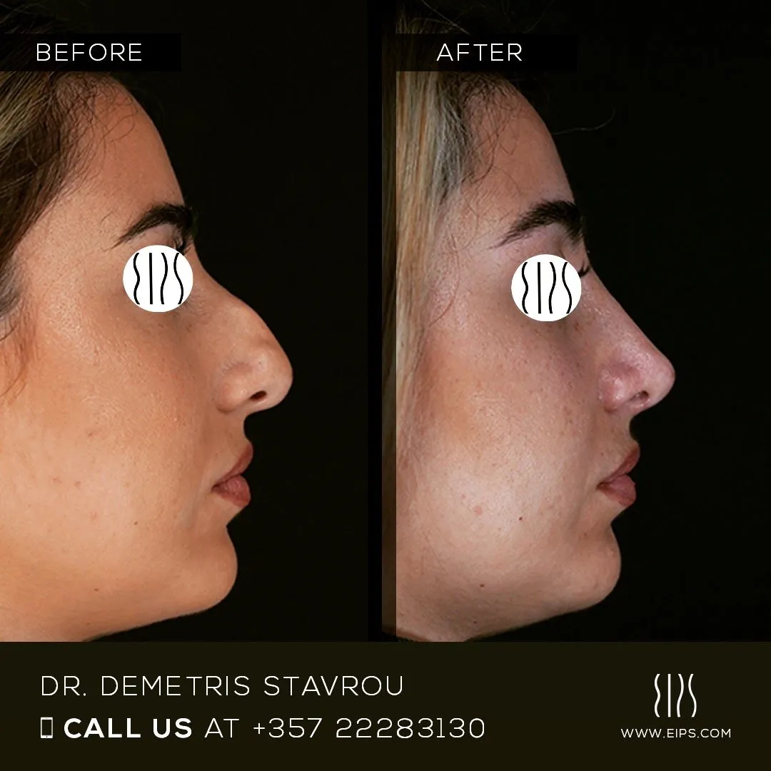 Rhinoplasty before and after