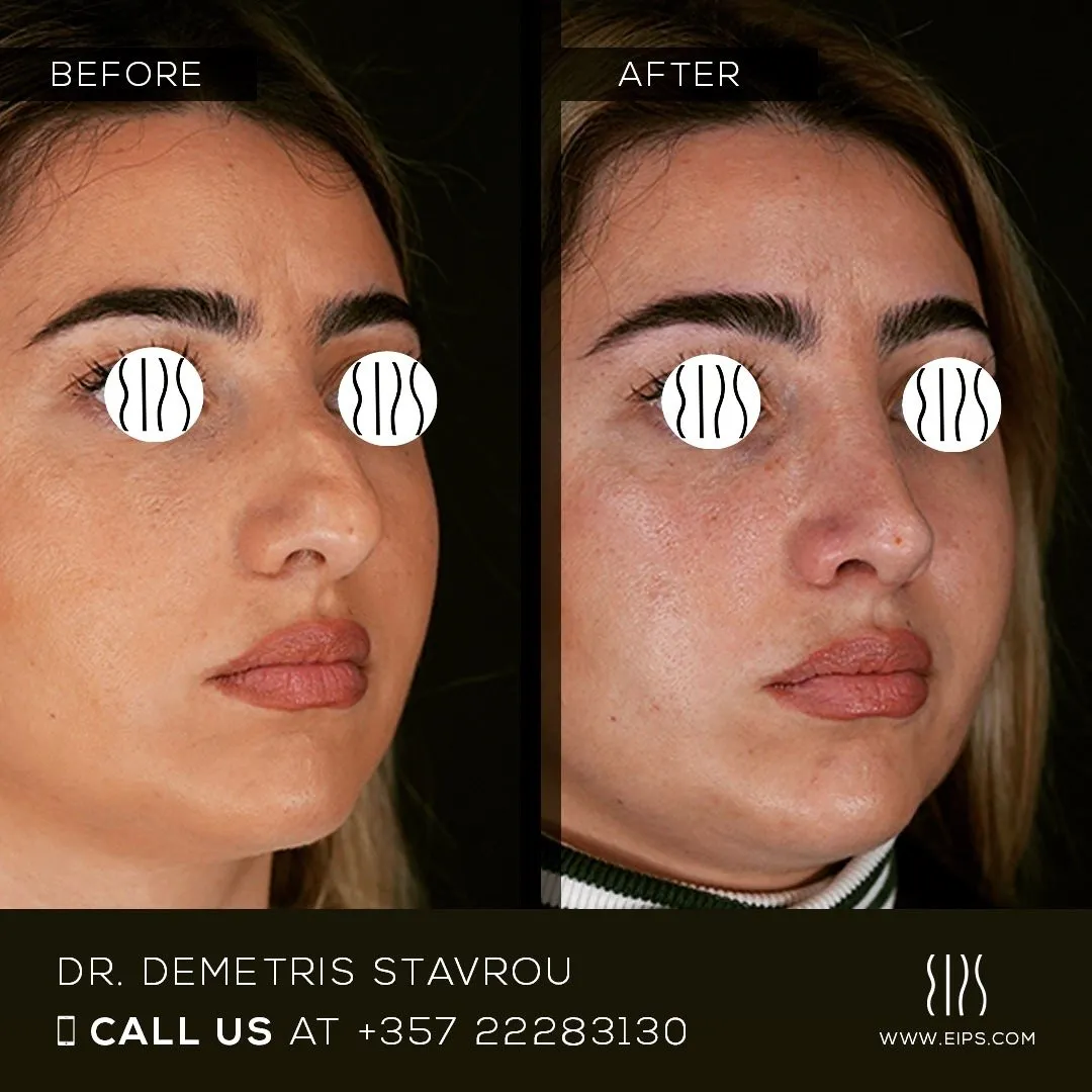Rhinoplasty before and after