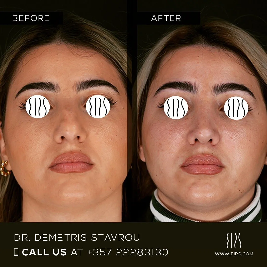 Rhinoplasty before and after