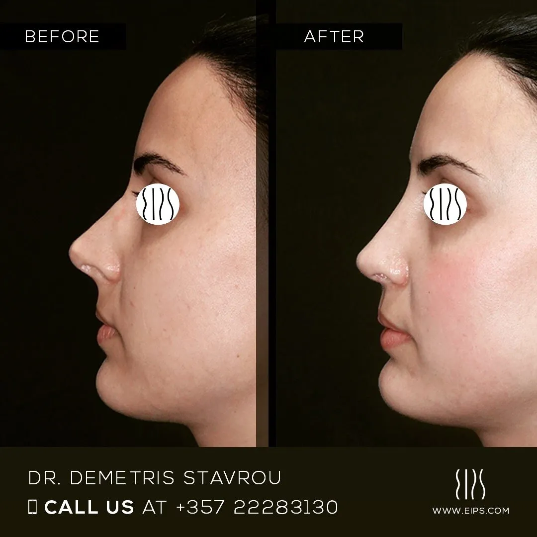 Rhinoplasty before and after