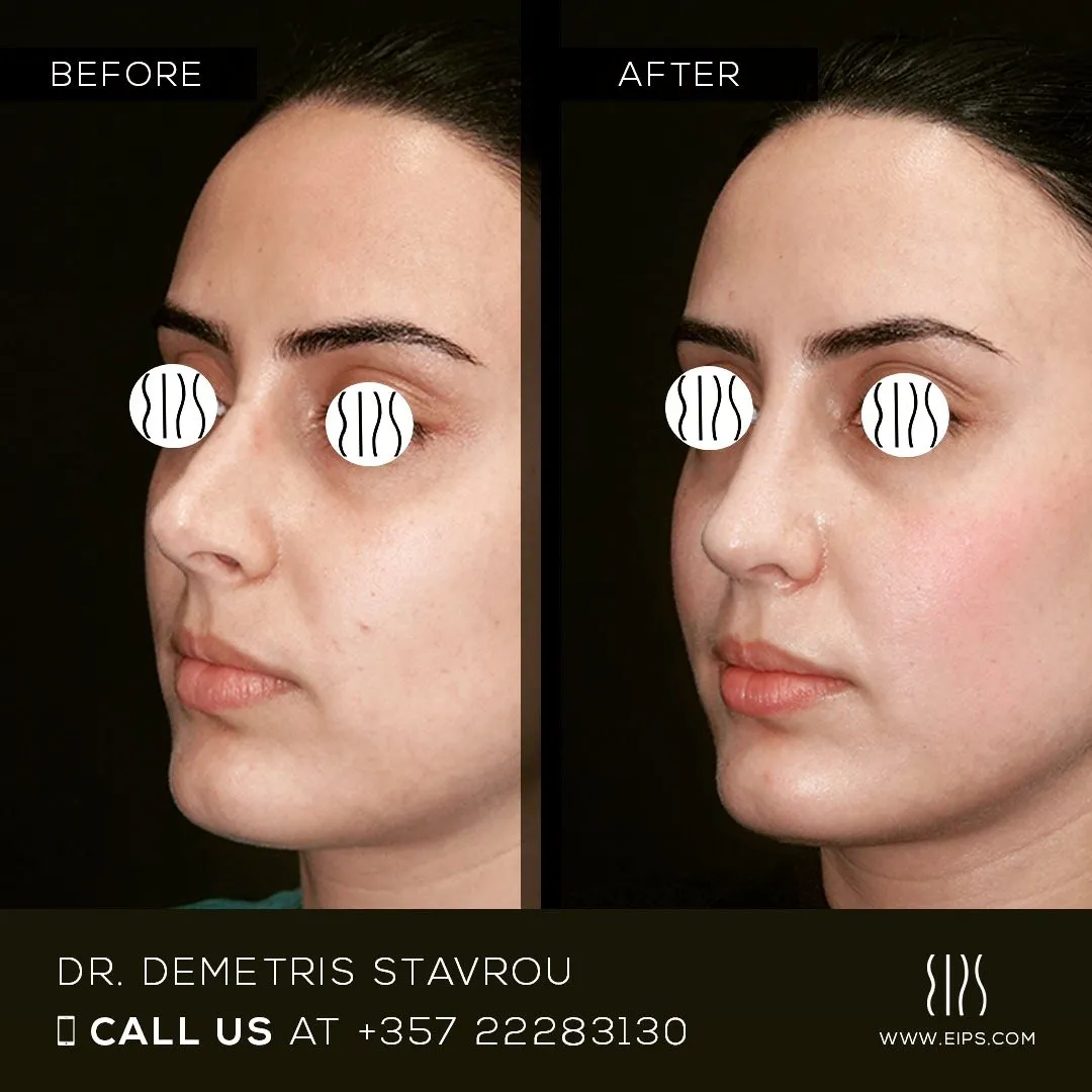 Rhinoplasty before and after