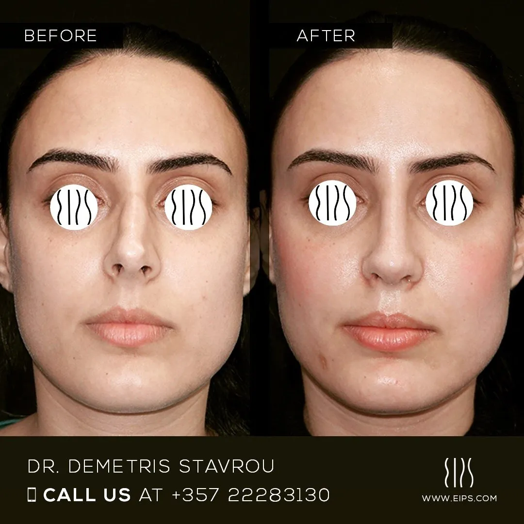 Rhinoplasty before and after
