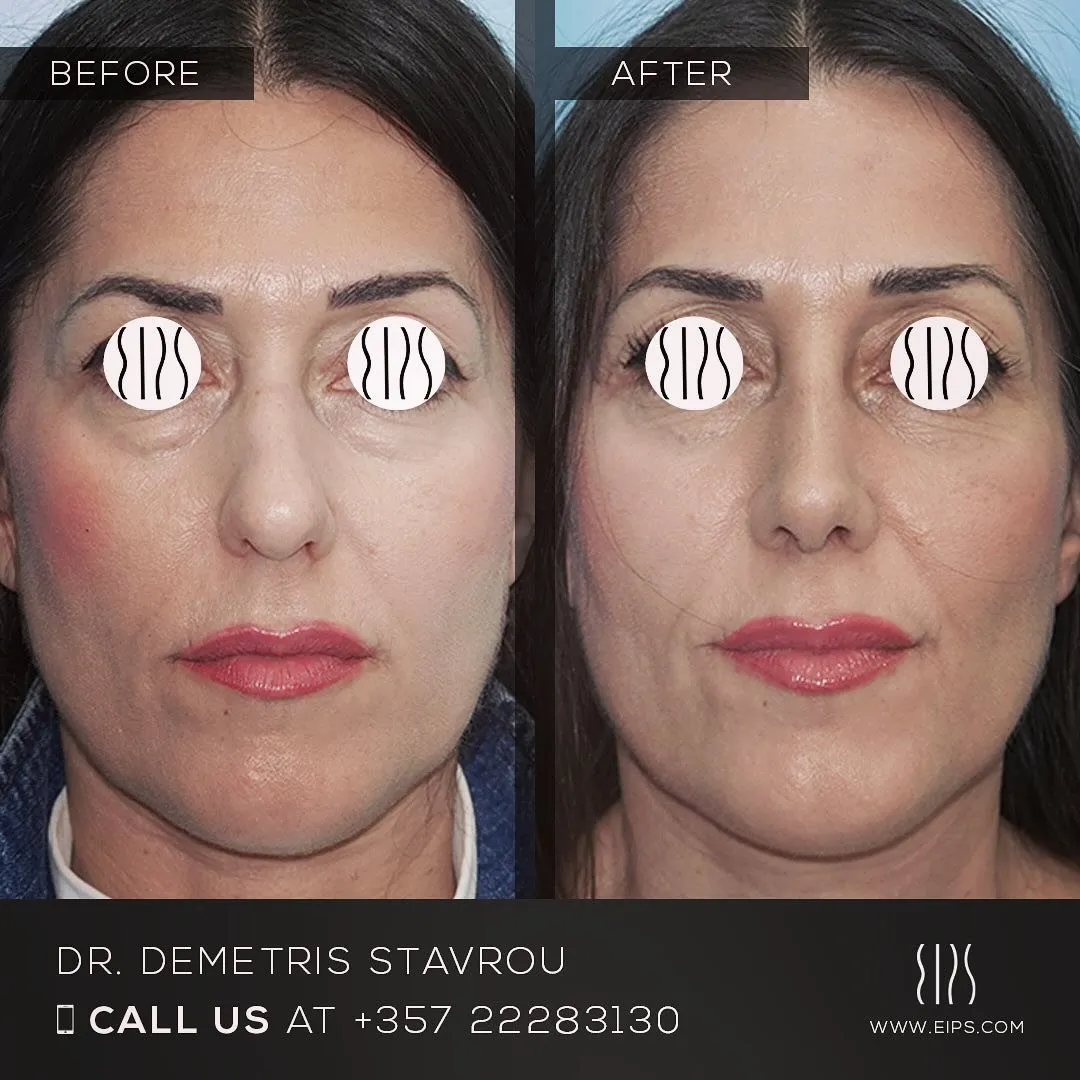 Rhinoplasty before and after