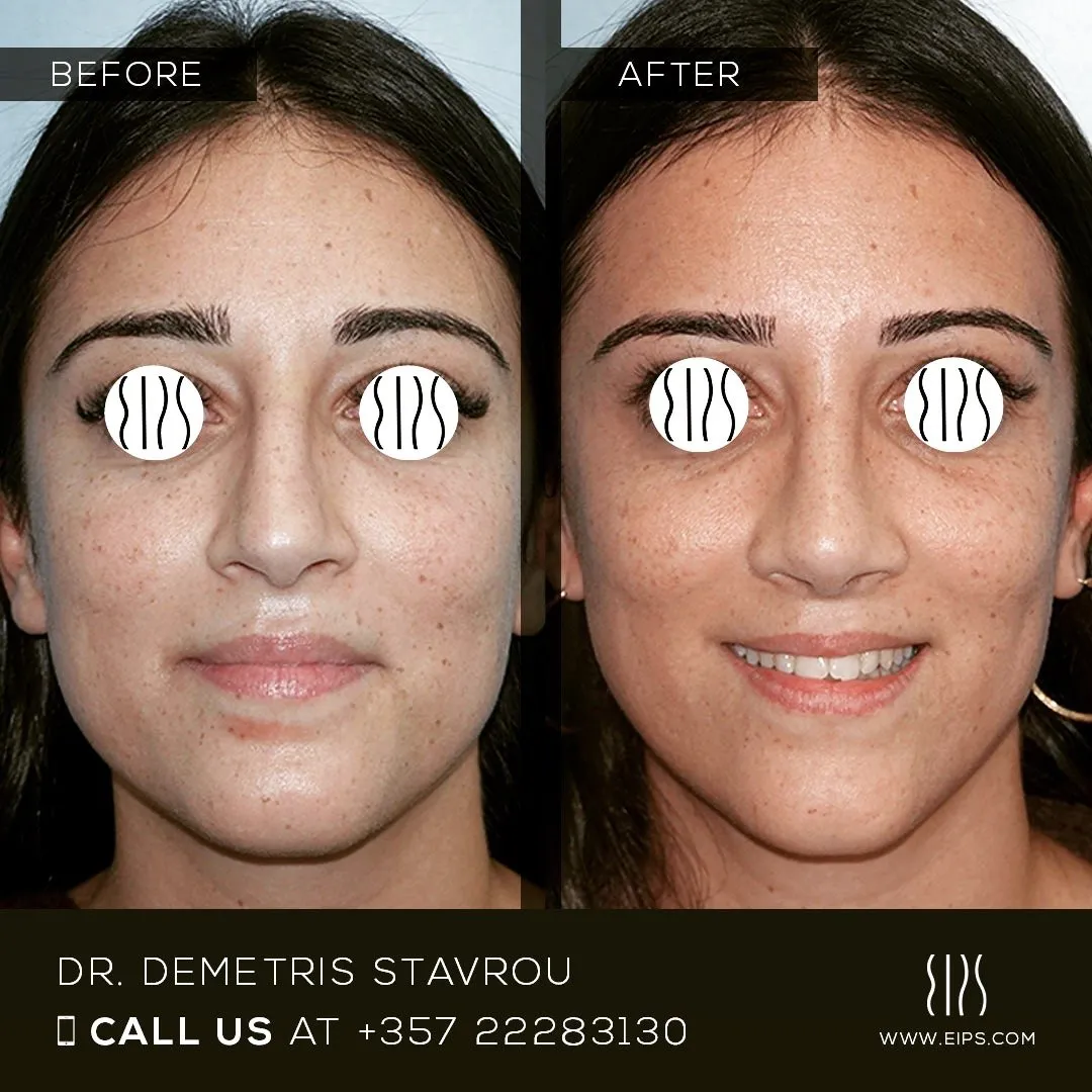 Rhinoplasty before and after