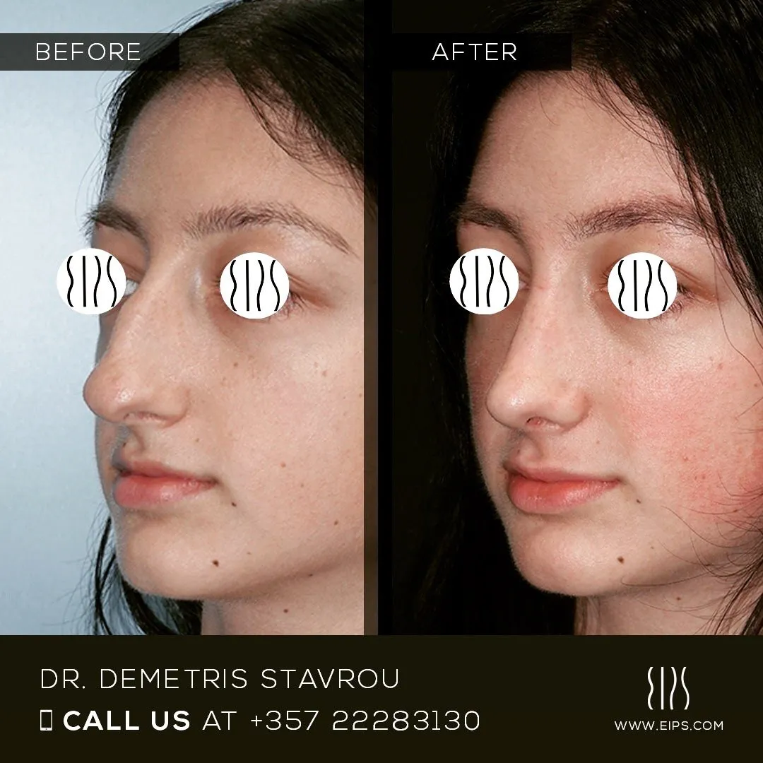 Rhinoplasty before and after