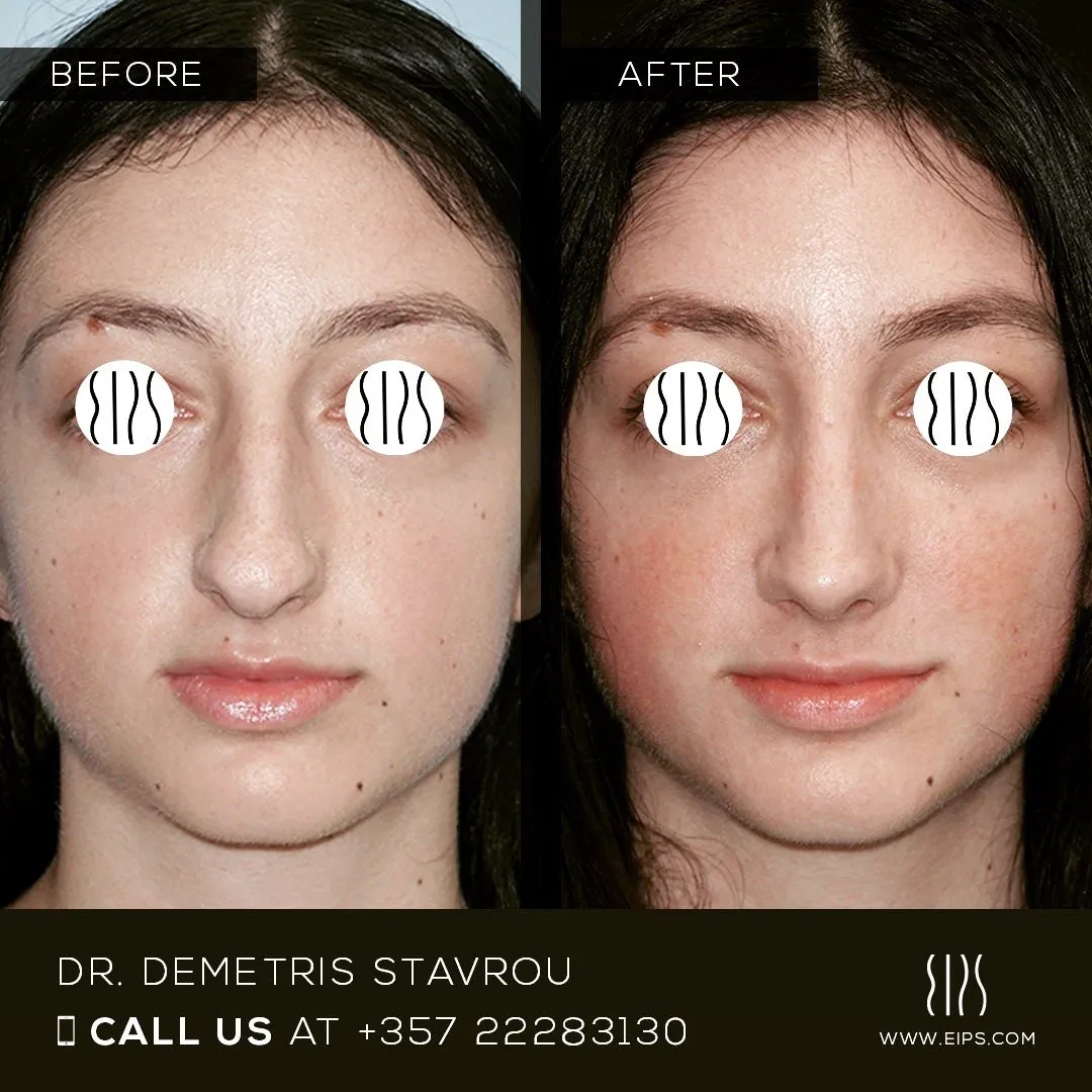 Rhinoplasty before and after