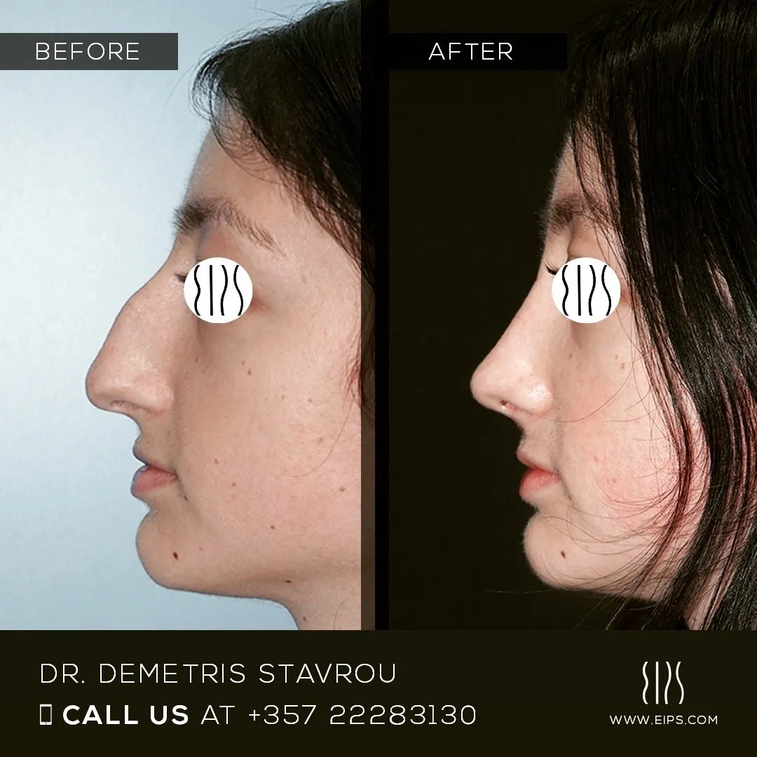 Rhinoplasty before and after